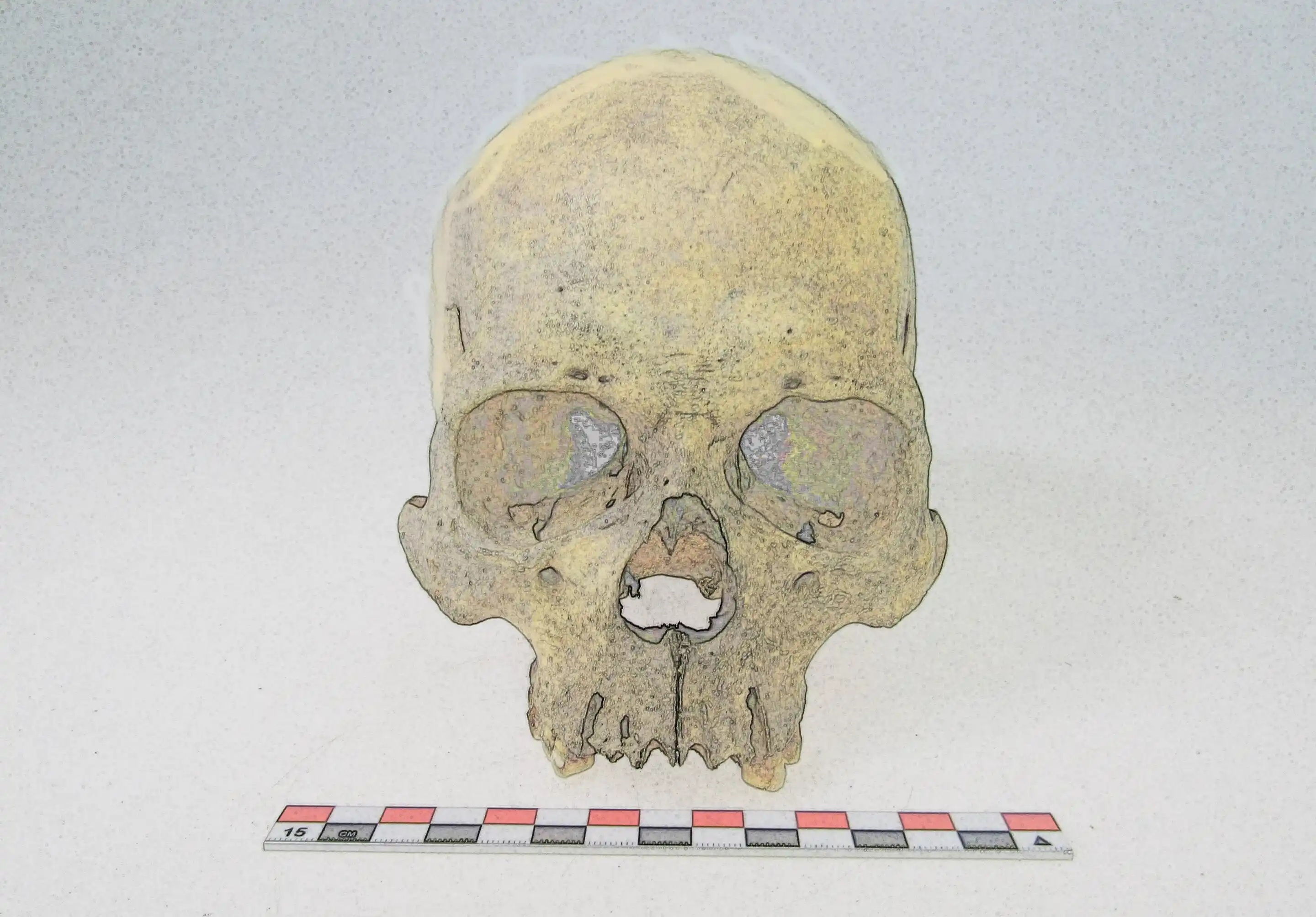 Rare leprosy strain in Americas